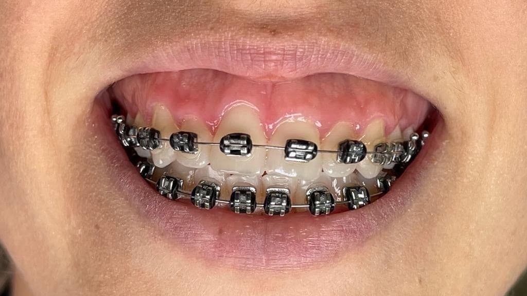 Alinhadores dentários clear correct