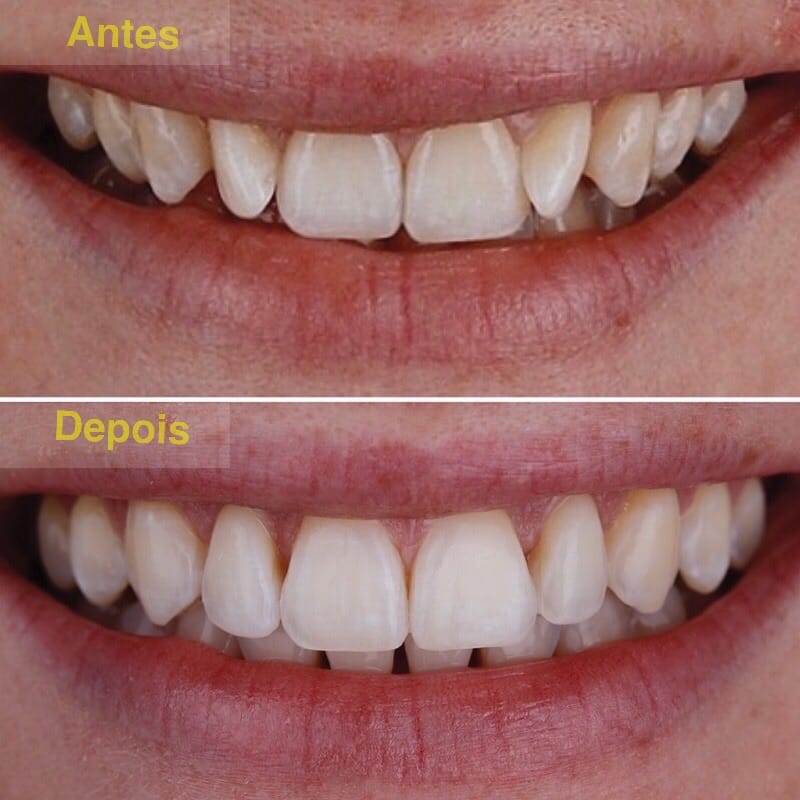 https://mllyg7nbferl.i.optimole.com/cb:ql8s.2dc18/w:800/h:800/q:mauto/f:best/https://www.alinhador-ortodontia.com//wp-content/uploads/2022/07/clinica-Ortodontia-Menino-deus-porto-alegre-gunther-implante-dental-10.jpeg